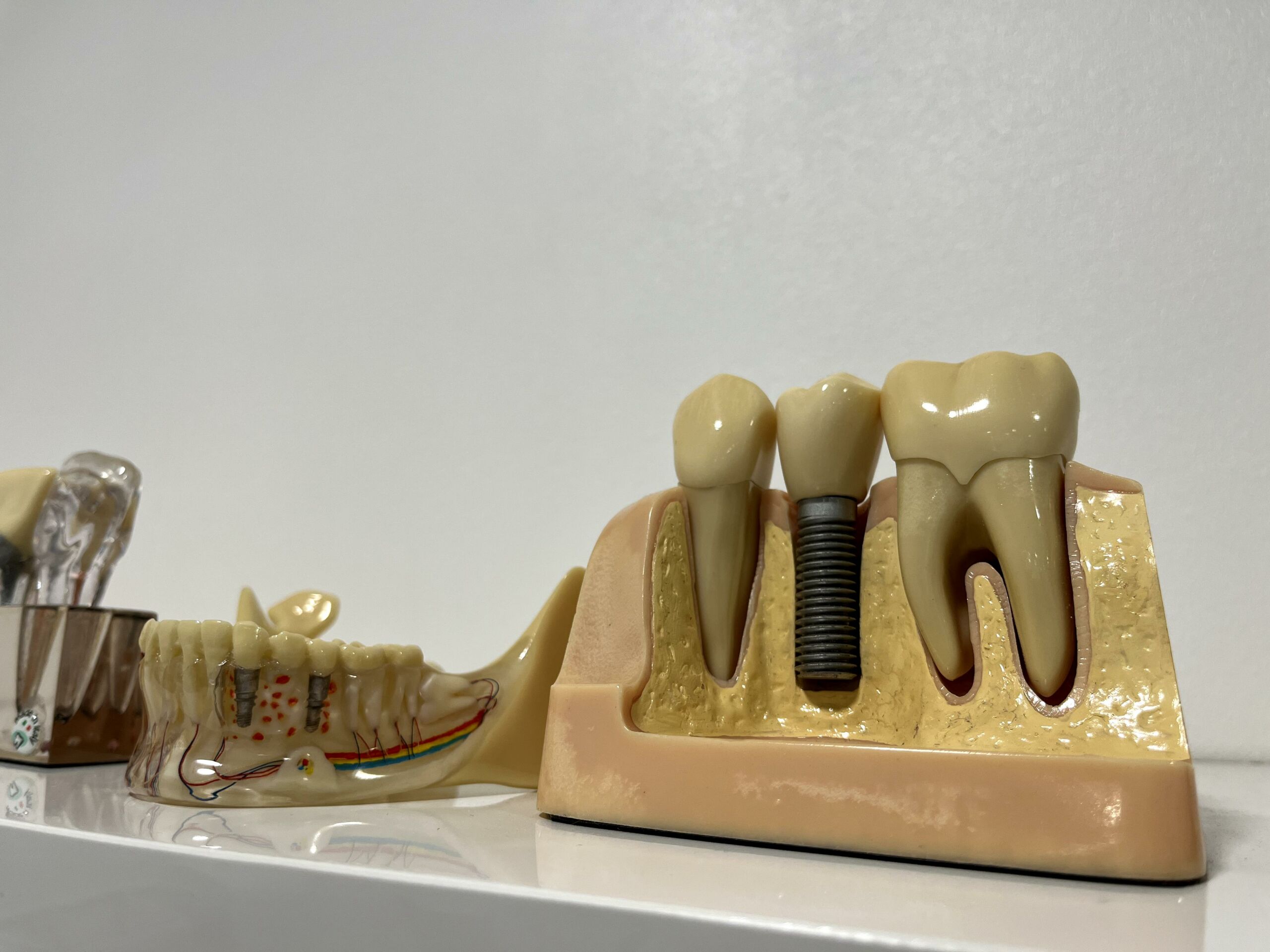 dental-implants-Dublin 2